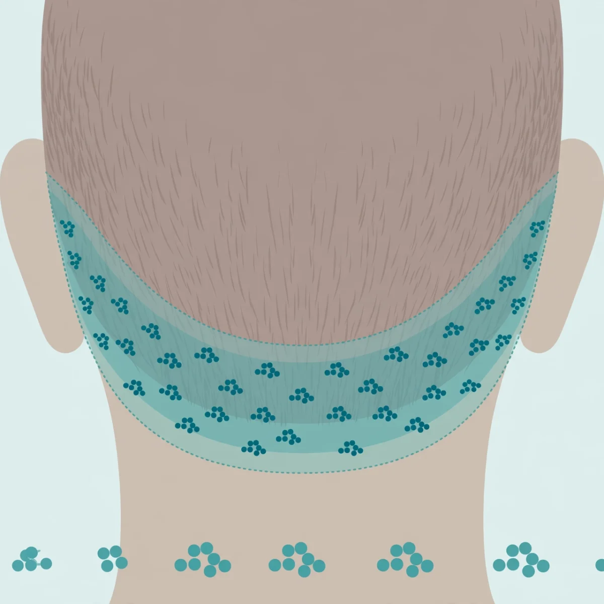 Medical illustration of the donor area at the back of the head highlighted for hair transplantation