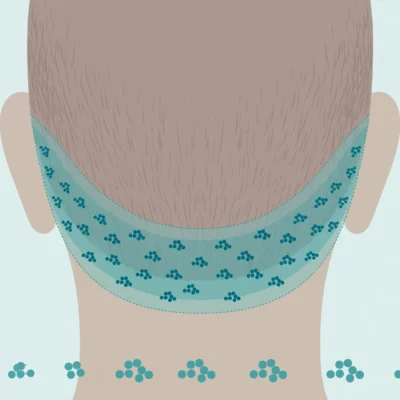 Medical illustration of the donor area at the back of the head highlighted for hair transplantation